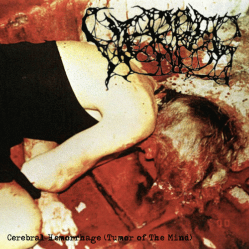 Cerebral Hemorrhage (Tumor of the Mind)